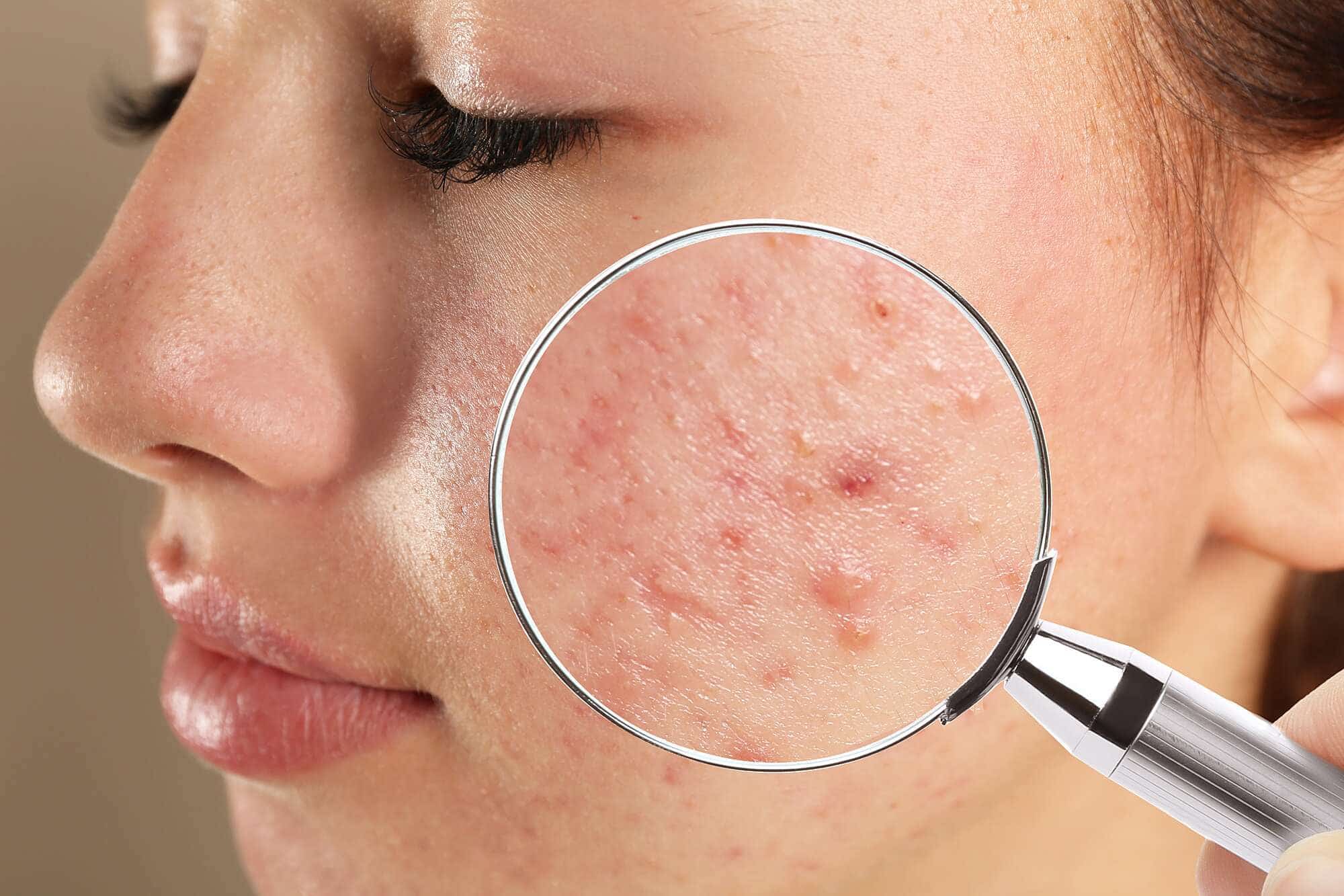 Acne Treatment-1a