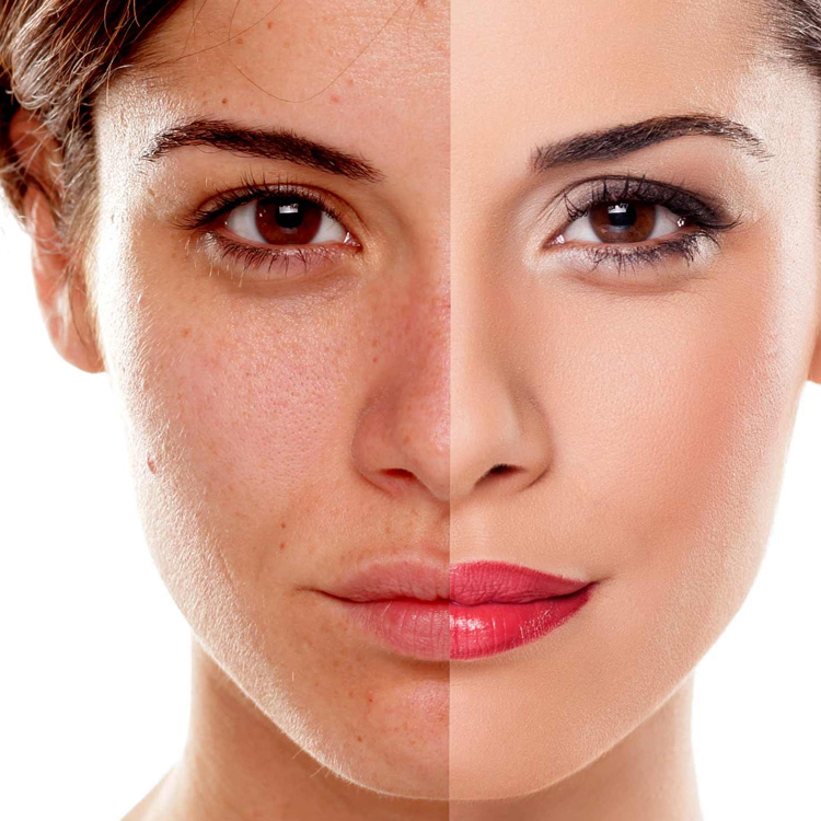 Pigmentation Treatment-1f
