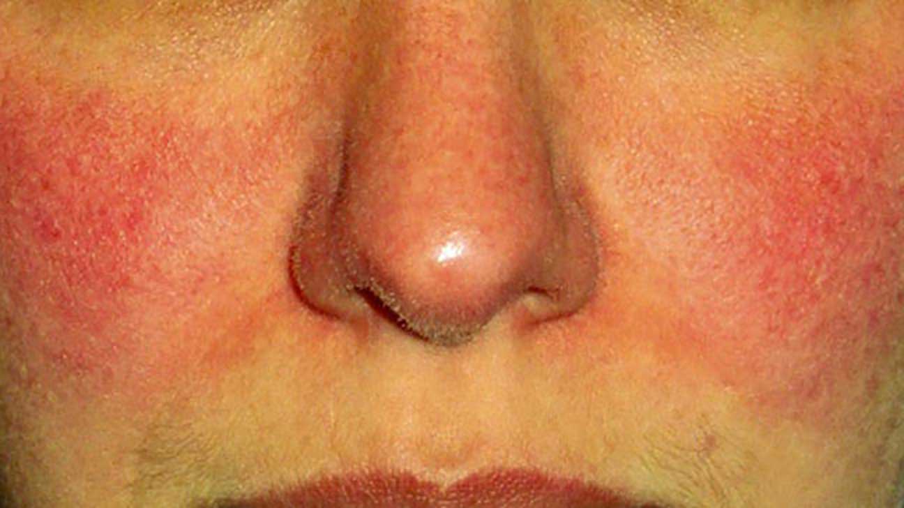 Sensitivity Treatment-2e
