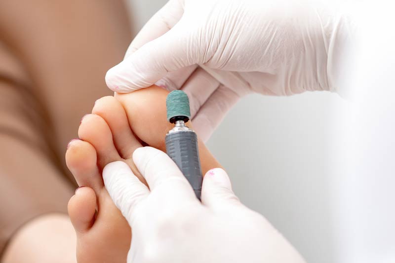 Callus Treatment-1a
