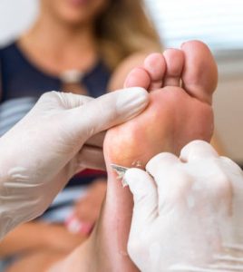 Chiropodist removes skin on a wart with a scalpel on the sole of Foot of a woman